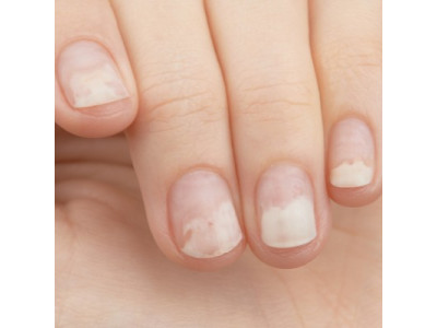 Что такое онихолизис и как его лечить