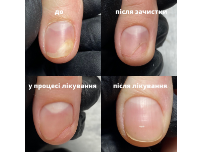 Что такое онихолизис и как его лечить