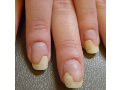 Что такое онихолизис и как его лечить